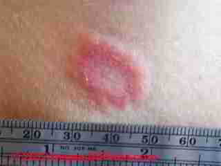 Mold skin rash found on exposure to high levels of Stachybotrys chartarum © D Friedman at InspectApedia.com 