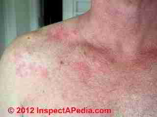 Skin rash on mold exposure © D Friedman at InspectApedia.com 