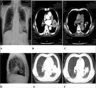 Lung cancer related X-rays from Kim (2013) cited in this article at InspectApedia.com