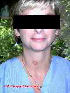 Mold skin rash found on exposure to high levels of Stachybotrys chartarum © D Friedman at InspectApedia.com 