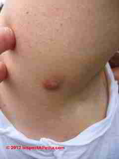 Raised round skin rash following mold exposure © D Friedman at InspectApedia.com 