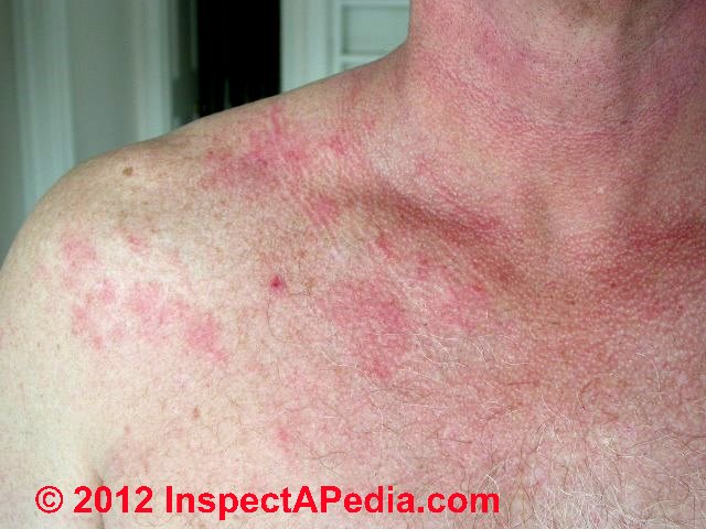 fine skin rash