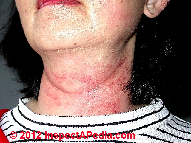 skin rashes on necks