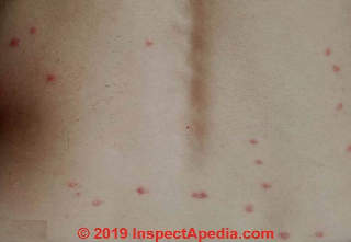 Bedbug bite pattern is characteristic and helps identify theim (C) Daniel Friedman at InspectApedia.com
