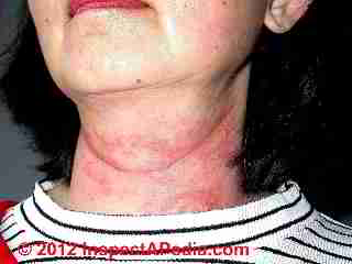 Neck rash from mold exposure © D Friedman at InspectApedia.com 